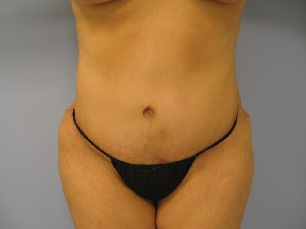 Mommy Makeover Before & After Image