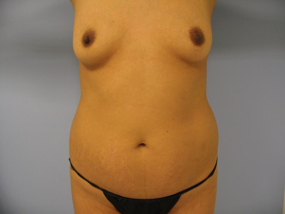 Mommy makeover Before & After Image