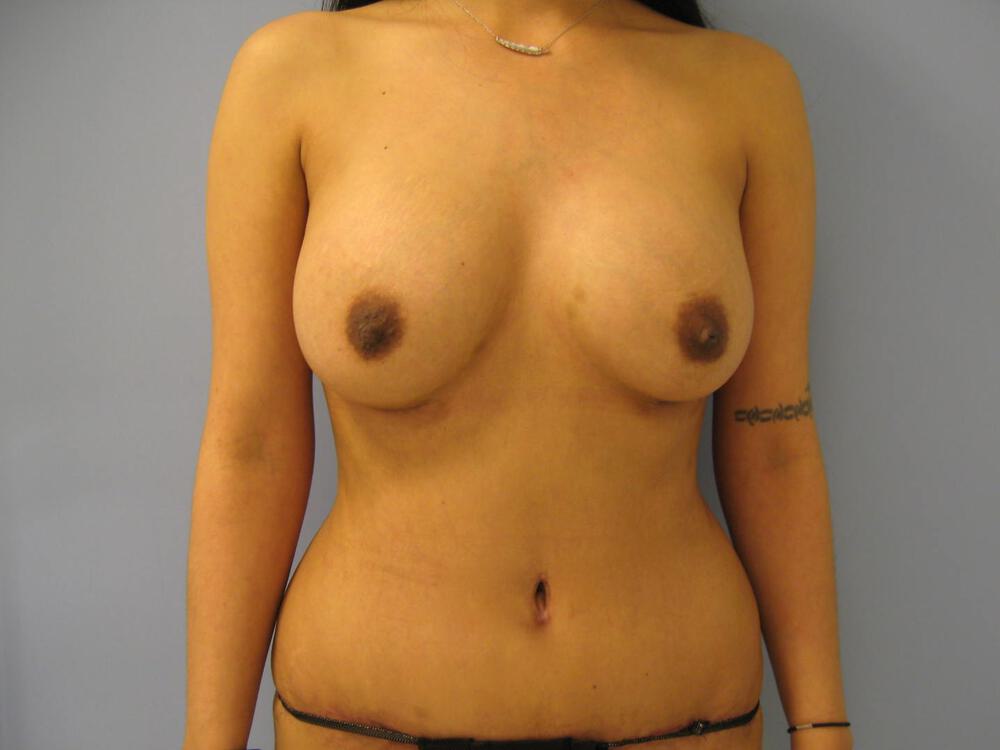 Mommy makeover Before & After Image