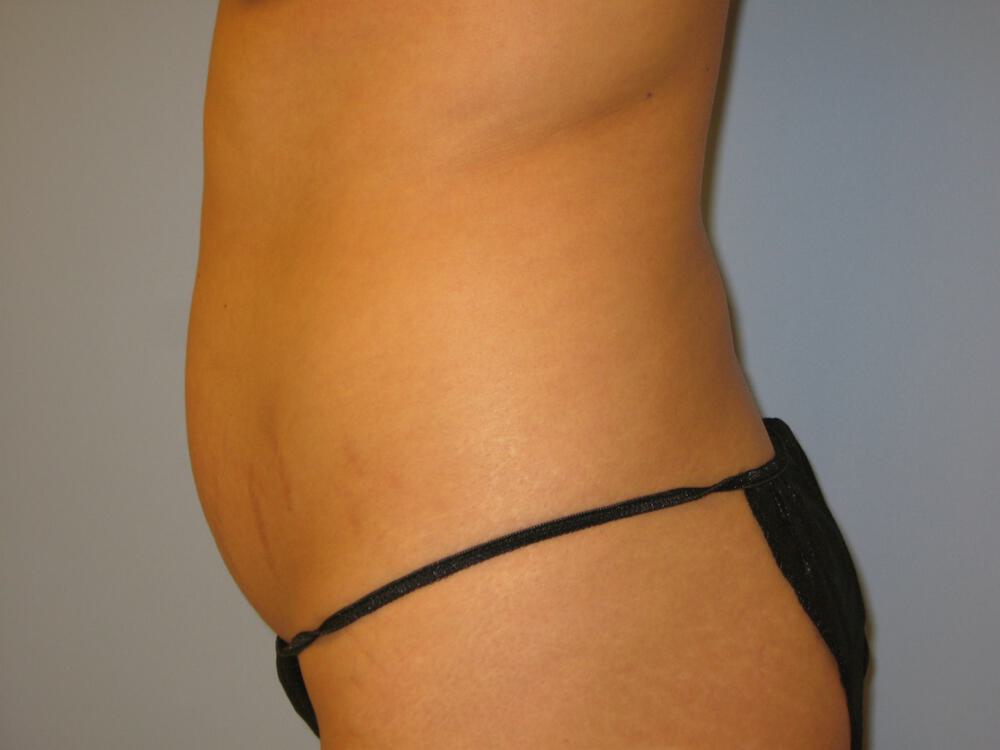 Mommy makeover Before & After Image