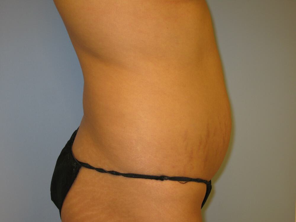 Mommy Makeover Before & After Image