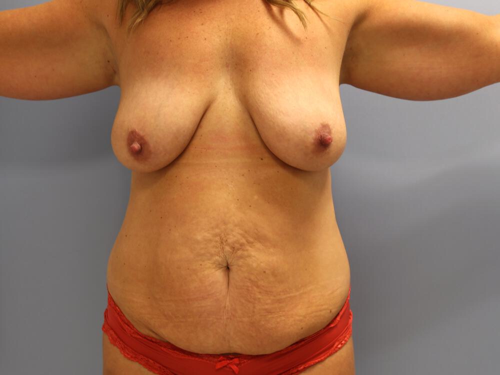 Mommy makeover Before & After Image