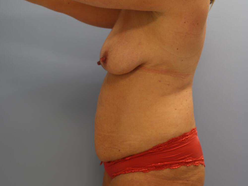 Mommy makeover Before & After Image