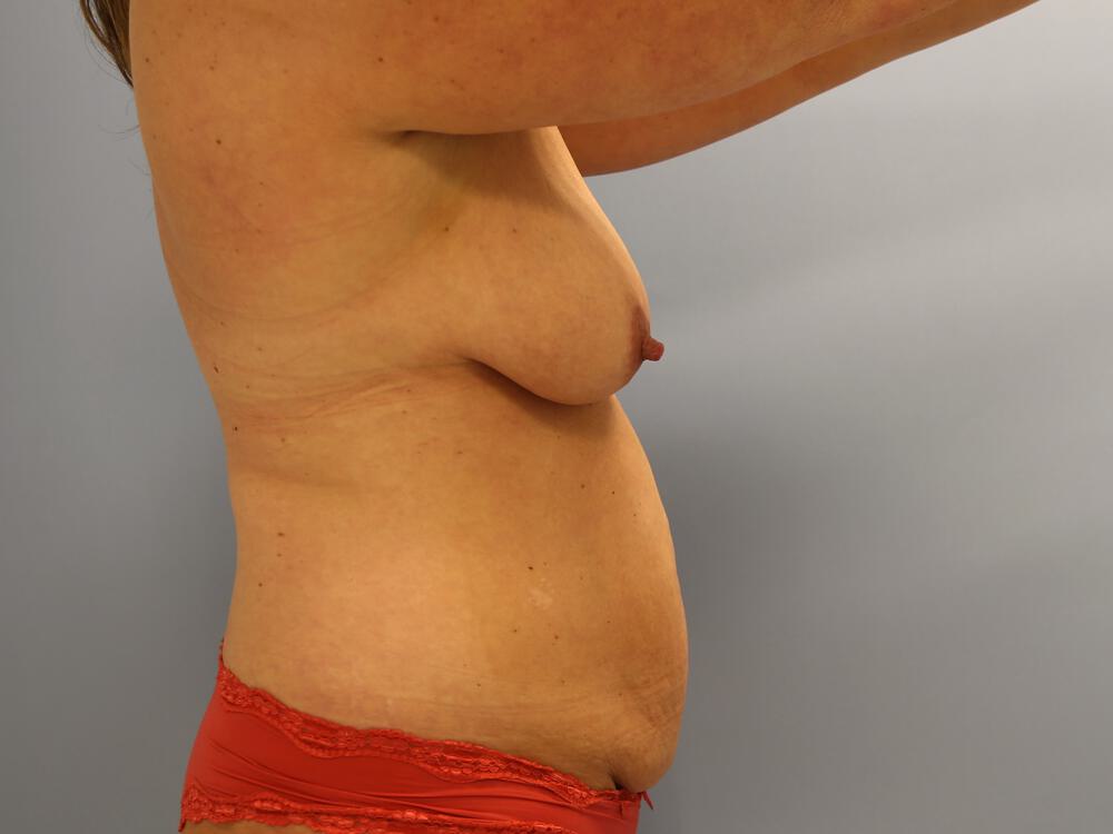 Mommy Makeover Before & After Image