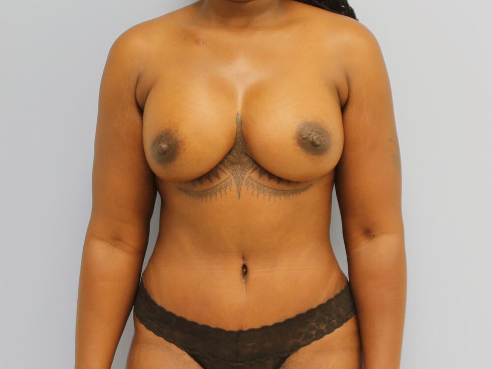 Mommy makeover Before & After Image