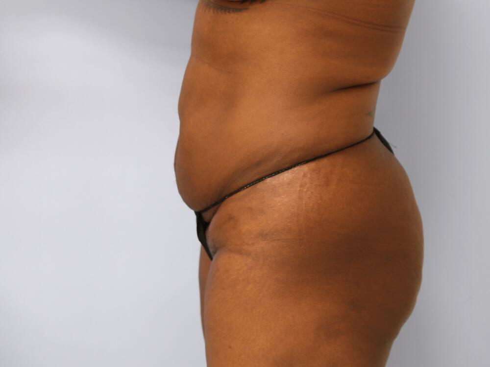 Mommy makeover Before & After Image