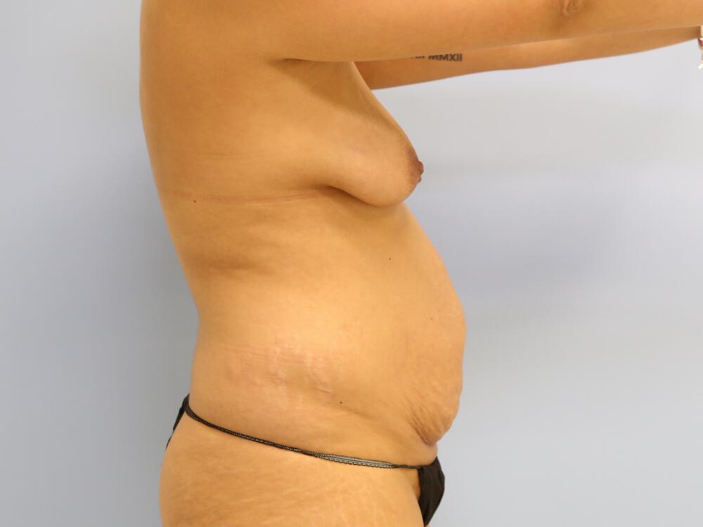 Mommy makeover Before & After Image