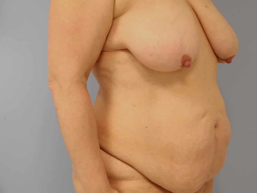 Mommy makeover Before & After Image