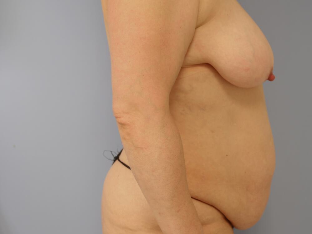 Mommy Makeover Before & After Image