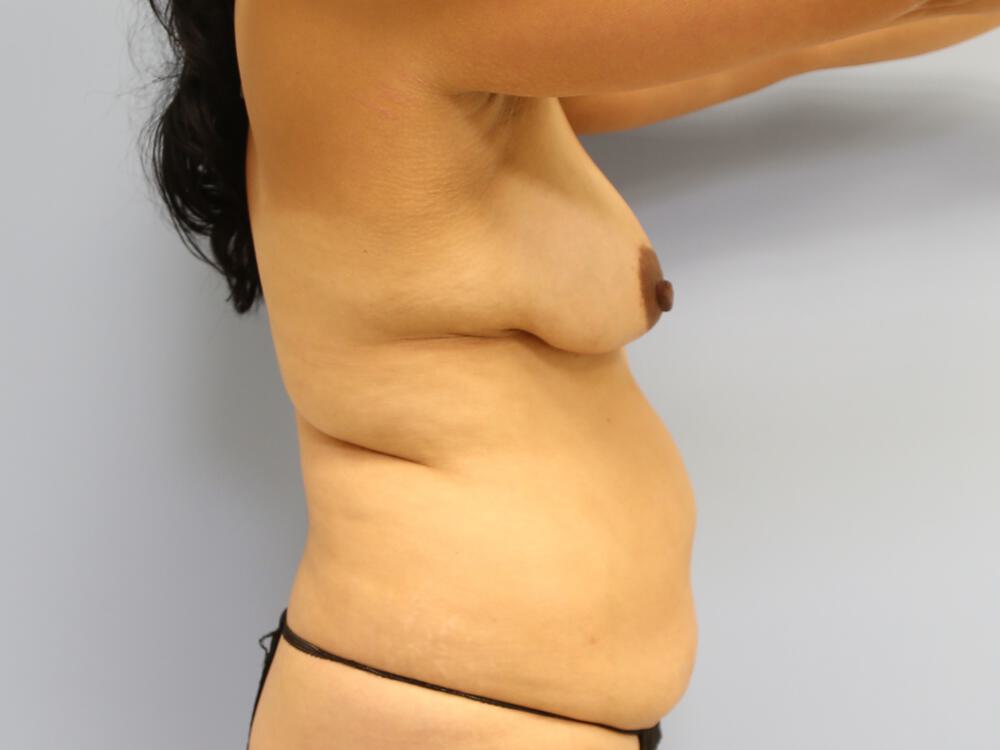 Mommy makeover Before & After Image