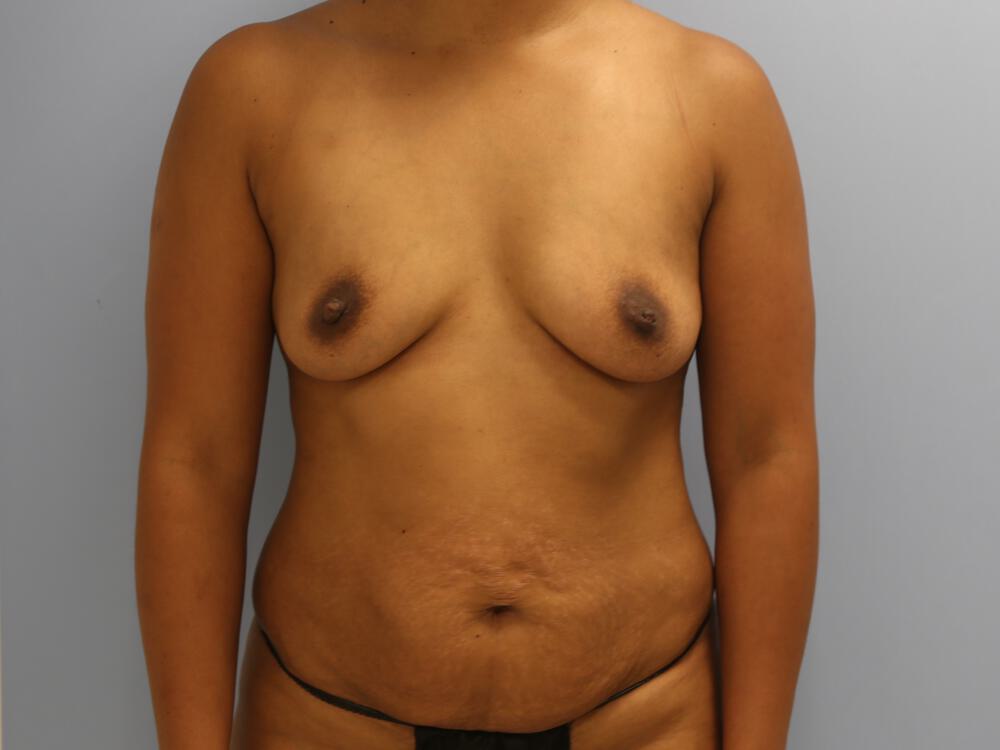 Mommy makeover Before & After Image