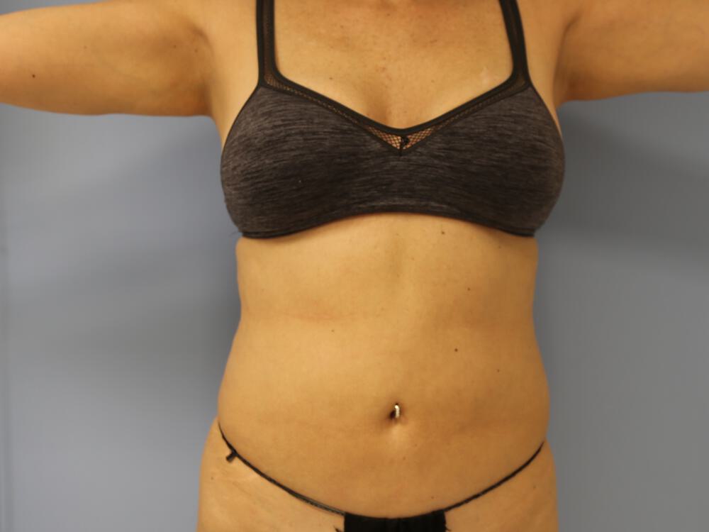 Mommy makeover Before & After Image