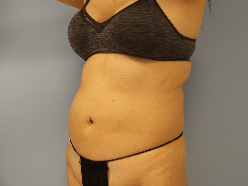 Mommy makeover Before & After Image