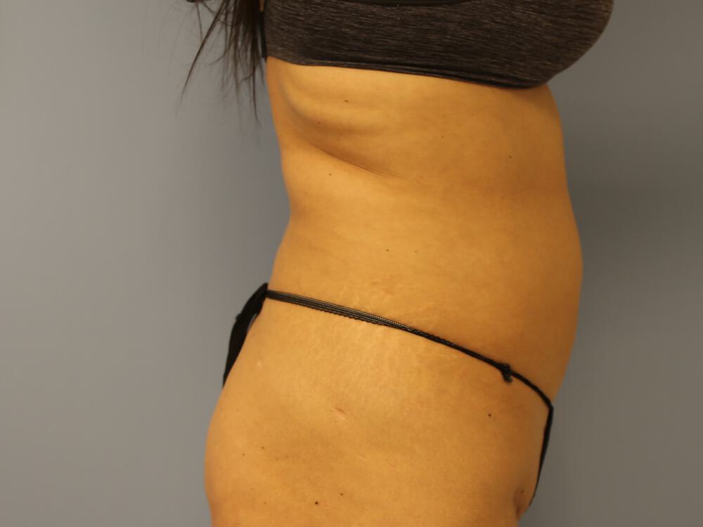 Mommy Makeover Before & After Image