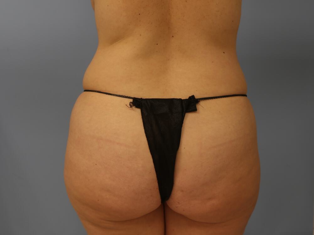 Mommy Makeover Before & After Image