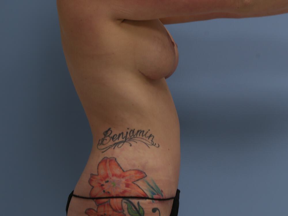 Mommy makeover Before & After Image