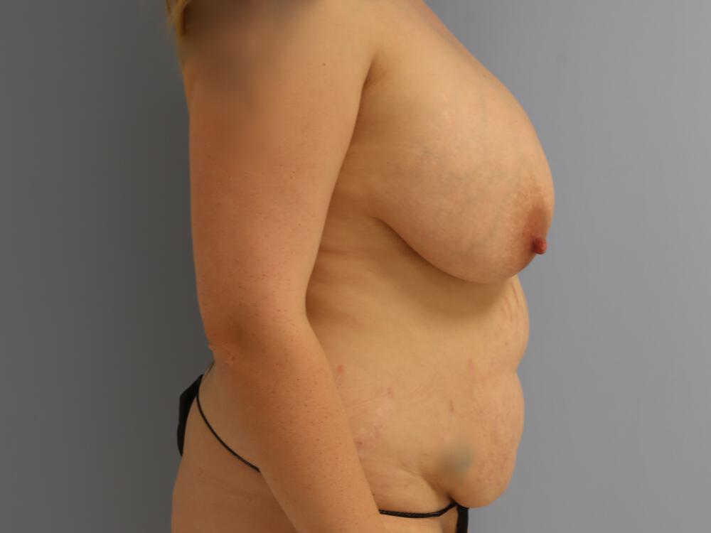 Mommy makeover Before & After Image