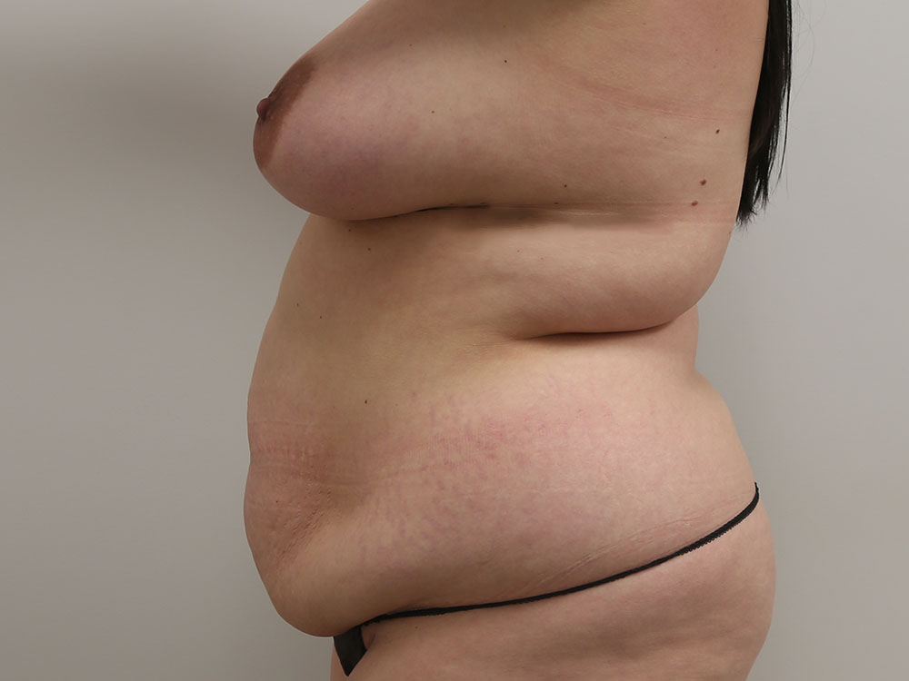 Mommy makeover Before & After Image