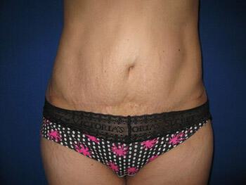 Revision Tummy Tuck Before & After Image