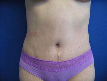 Revision Tummy Tuck Before & After Image