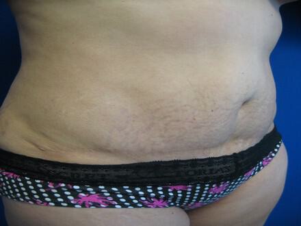 Revision Tummy Tuck Before & After Image