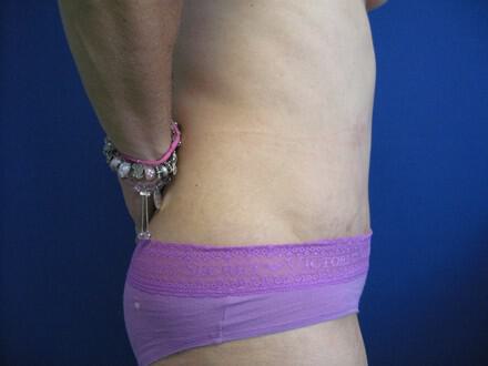 Revision Tummy Tuck Before & After Image