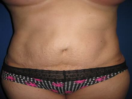 Revision Tummy Tuck Before & After Image