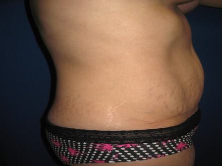 Revision Tummy Tuck Before & After Image