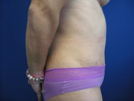Revision Tummy Tuck Before & After Image