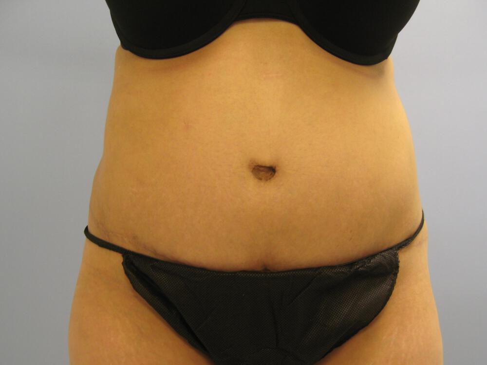 Revision Tummy Tuck Before & After Image
