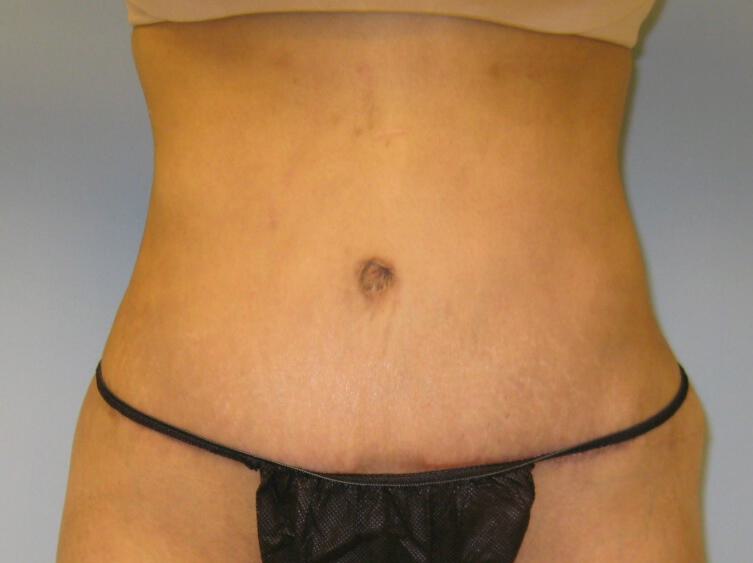 Revision Tummy Tuck Before & After Image