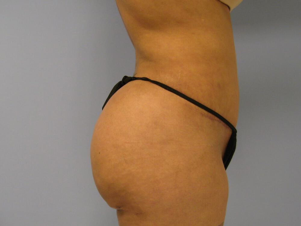 Revision Tummy Tuck Before & After Image