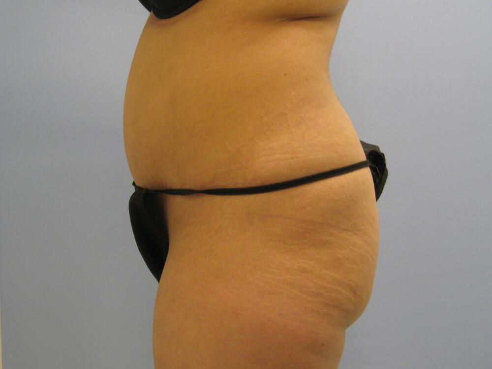 Revision Tummy Tuck Before & After Image