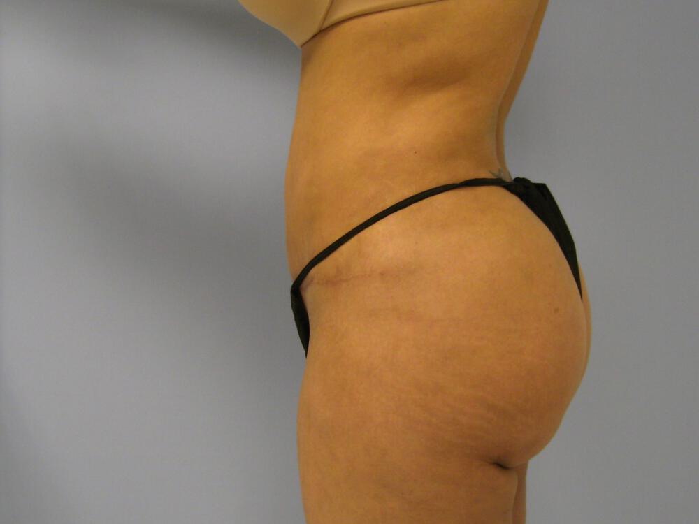 Revision Tummy Tuck Before & After Image