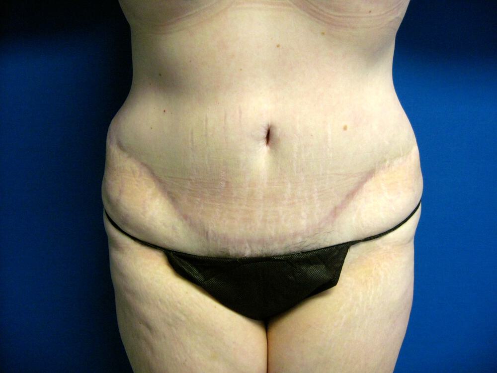 Revision tummy tuck Before & After Image