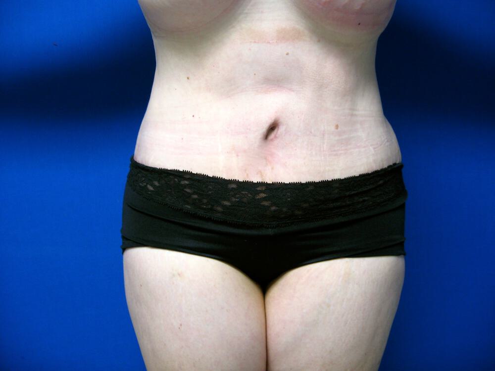 Revision tummy tuck Before & After Image