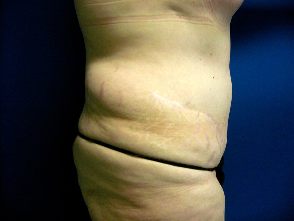 Revision tummy tuck Before & After Image