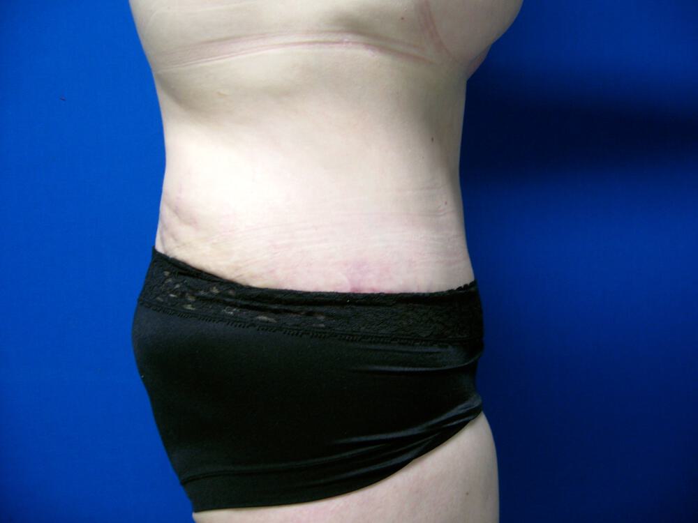 Revision tummy tuck Before & After Image