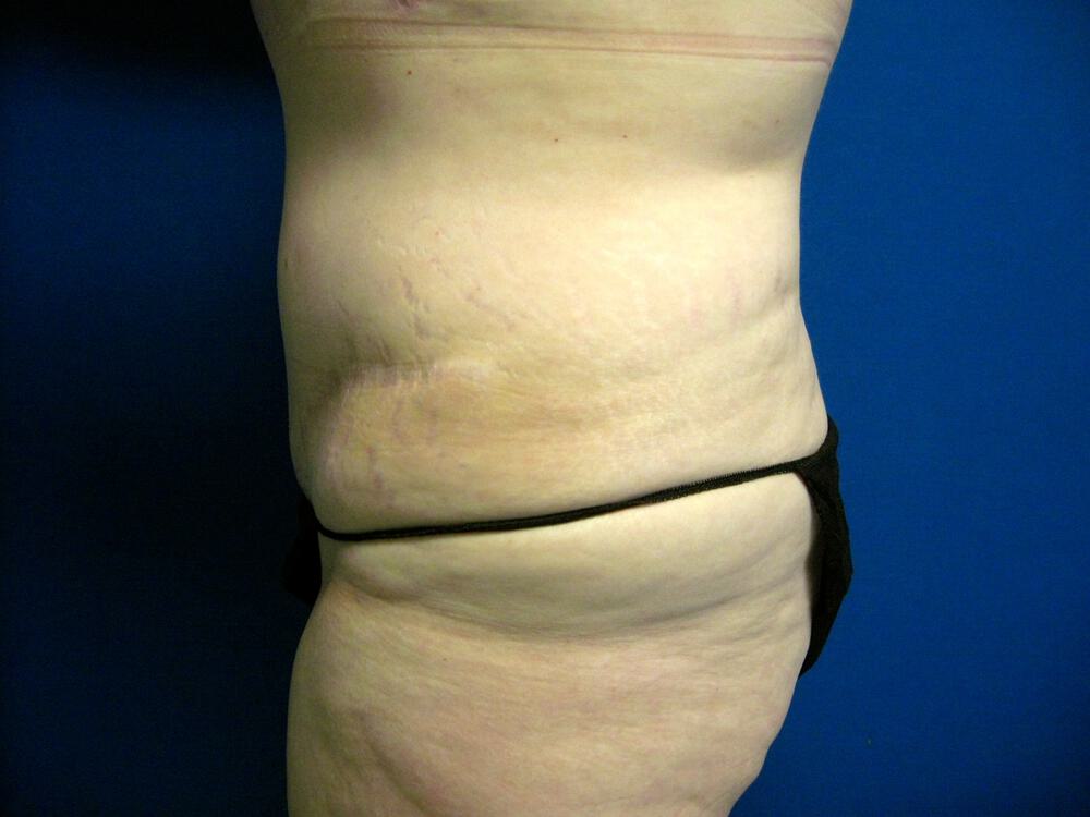 Revision Tummy Tuck Before & After Image