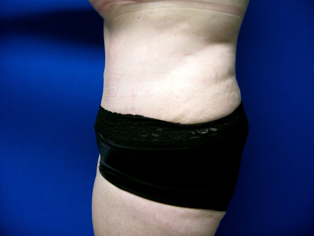 Revision Tummy Tuck Before & After Image