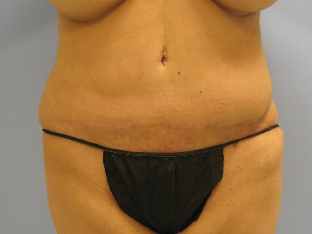 Revision tummy tuck Before & After Image