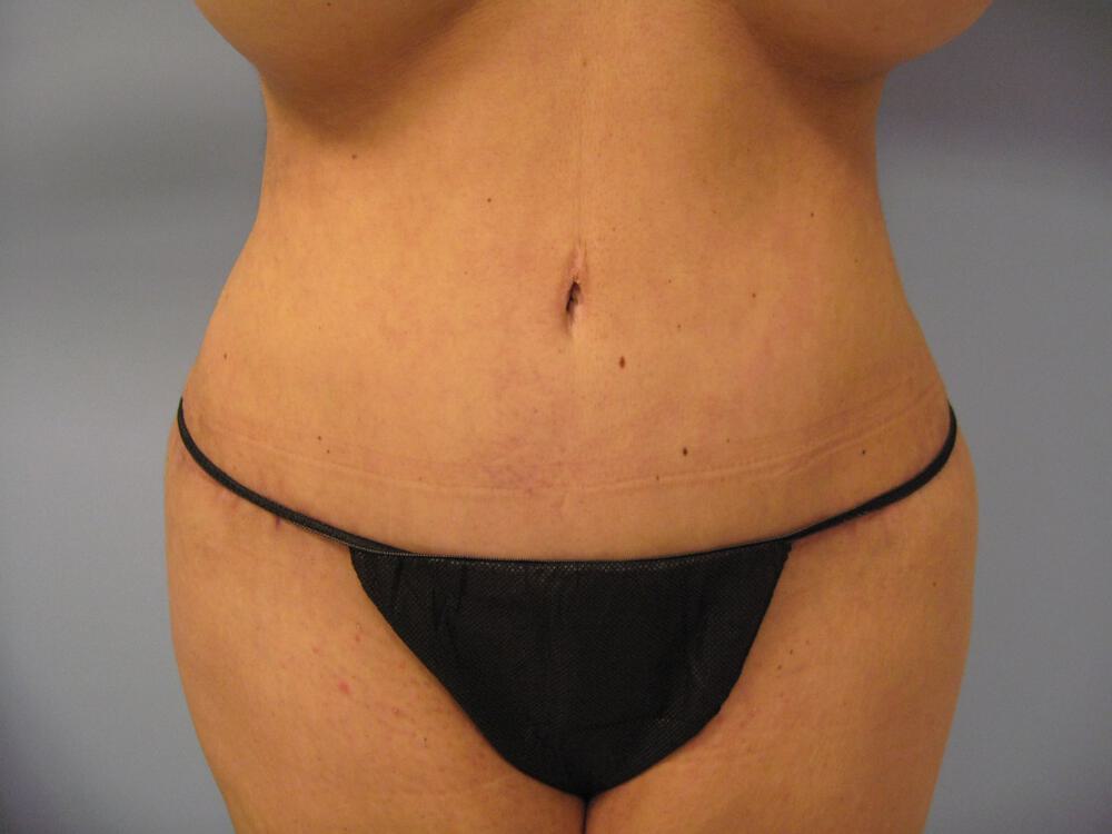 Revision tummy tuck Before & After Image