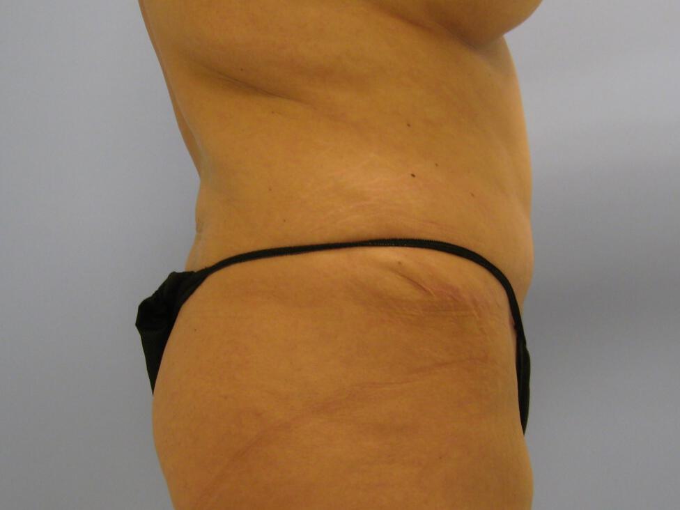 Revision tummy tuck Before & After Image