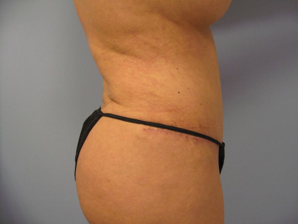Revision tummy tuck Before & After Image
