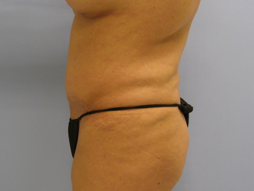Revision Tummy Tuck Before & After Image