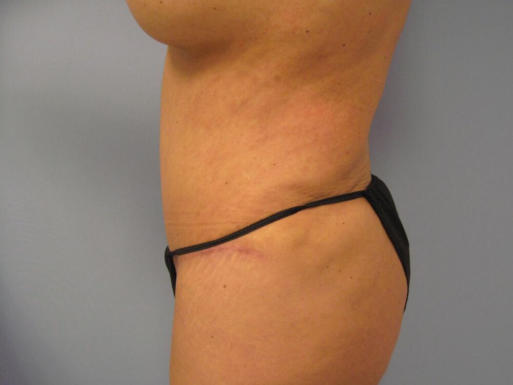 Revision Tummy Tuck Before & After Image