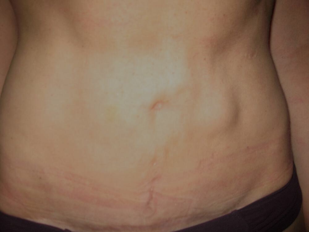 Revision tummy tuck Before & After Image