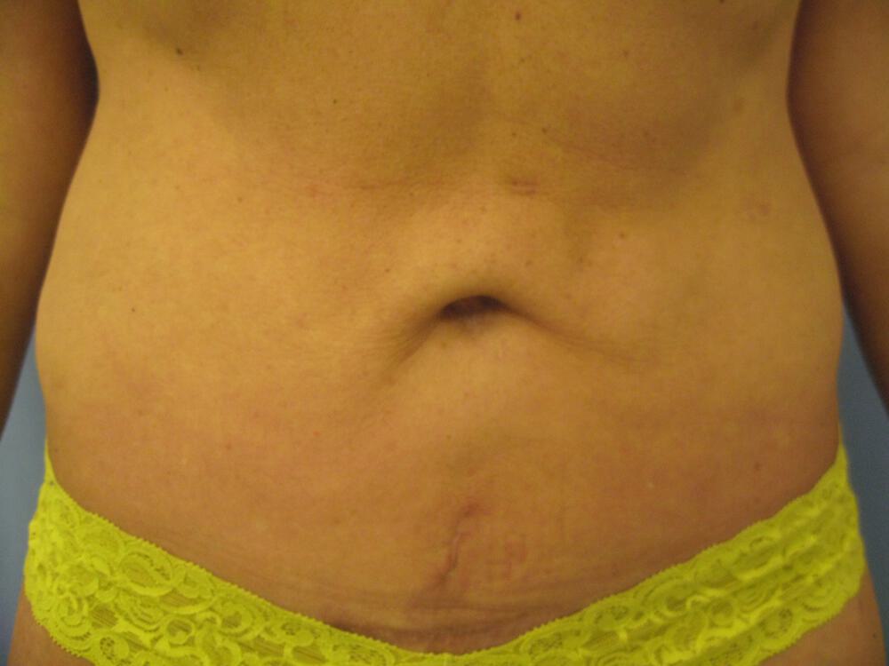 Revision tummy tuck Before & After Image