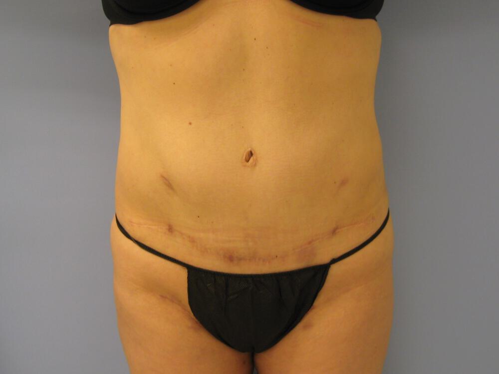 Revision tummy tuck Before & After Image