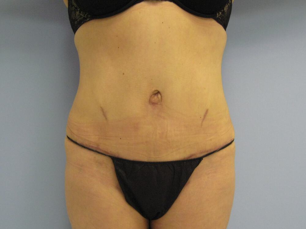 Revision tummy tuck Before & After Image